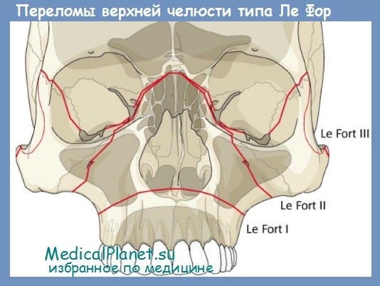 перелом верхней челюсти типа Ле Фор 3
