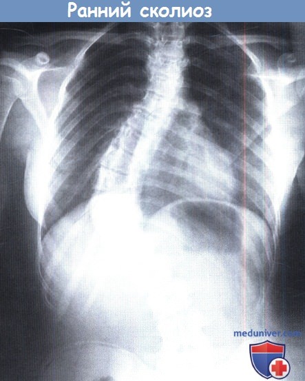 Рентгенограмма при раннем сколиозе