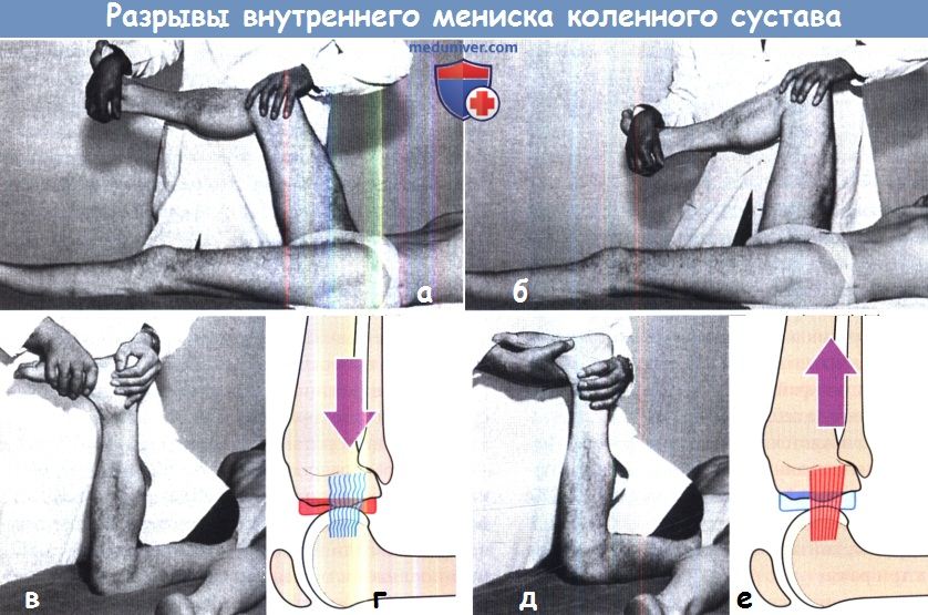 Разрывы внутреннего мениска коленного сустава