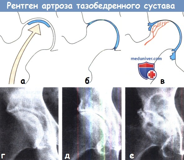 Рентген коксартроза - артроза тазобедренного сустава