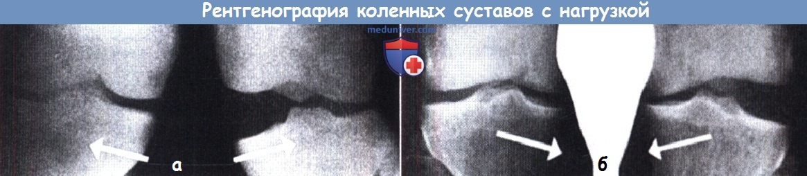Рентгенография коленных суставов с нагрузкой