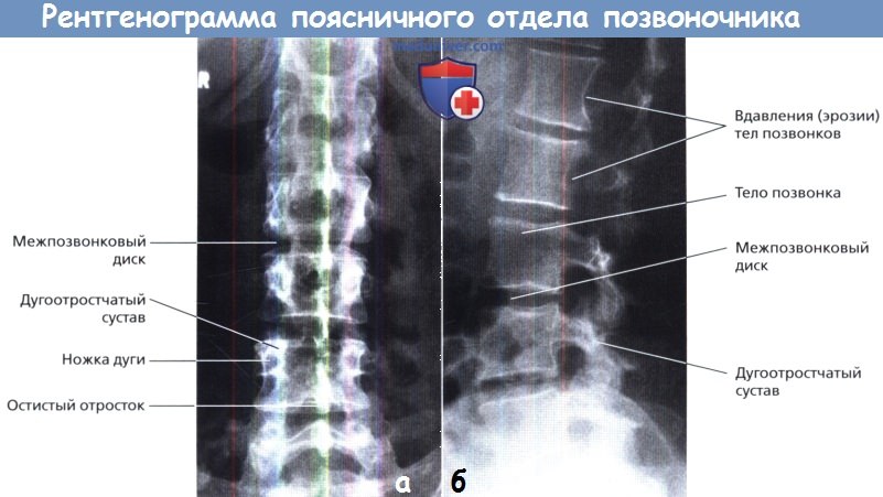 Рентгенограмма поясничного отдела позвоночника