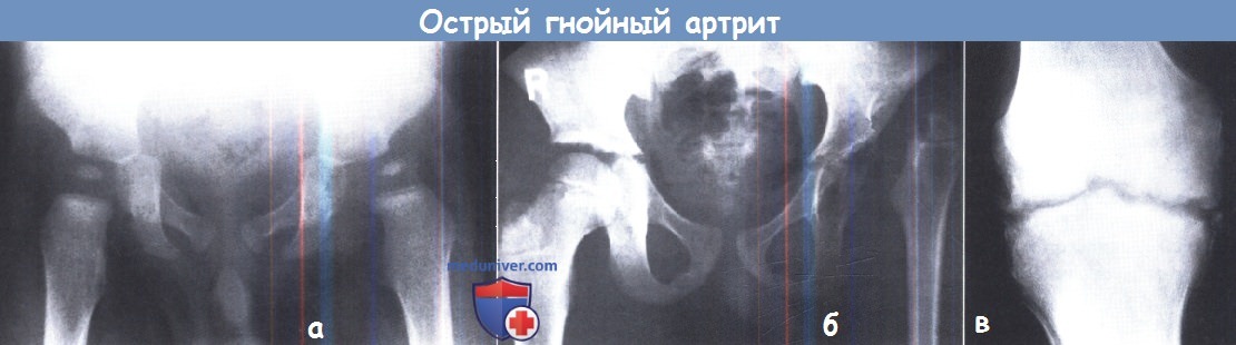 Рентгенограмма при остром гнойном артрите