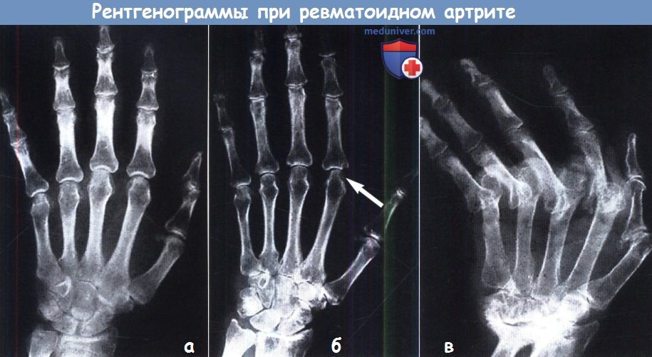 Рентгенограммы при ревматоидном артрите