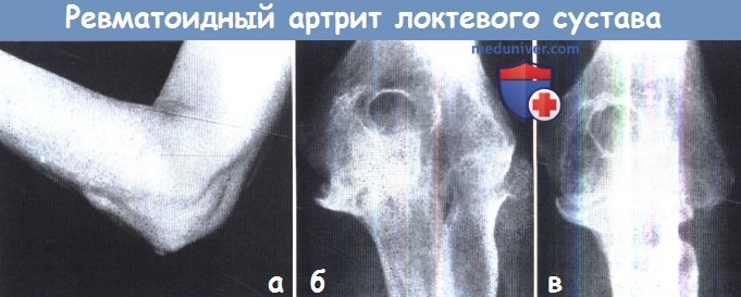 Ревматоидный артрит локтевого сустава