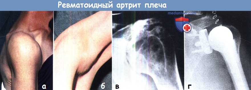 Ревматоидный артрит плеча