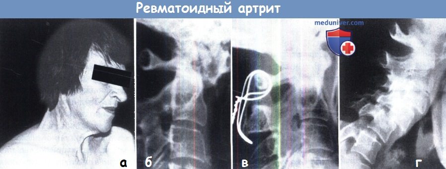Ревматоидный артрит шейного отдела позвоночника