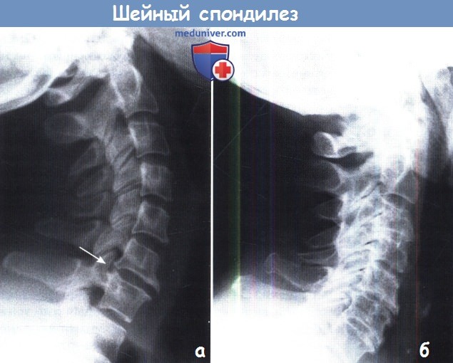 Шейный спондилез - рентгенограмма