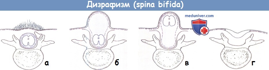  - spina bifida