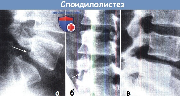 Рентгенография при спондилолистезе