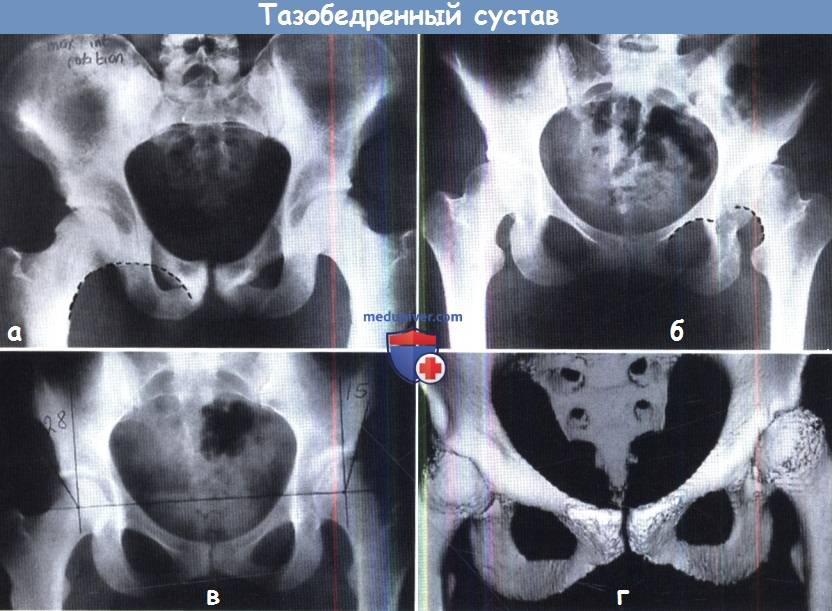 КТ и рентгенограмма тазобедренного сустава