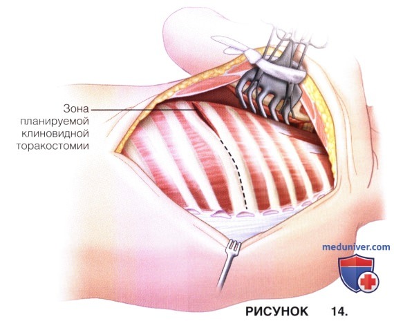 Доступ, техника операции VEPTR и открытой клиновидной торакостомии при лечении врожденных деформаций позвоночника