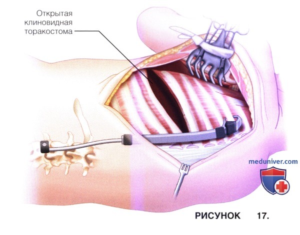 Доступ, техника операции VEPTR и открытой клиновидной торакостомии при лечении врожденных деформаций позвоночника