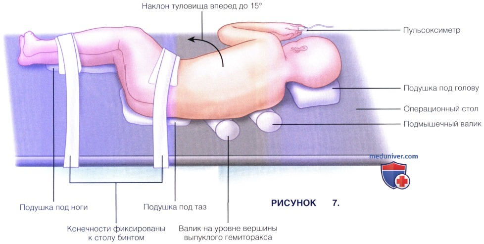 Показания, укладка пациента при VEPTR и открытой клиновидной торакостомии в лечении врожденных деформаций позвоночника