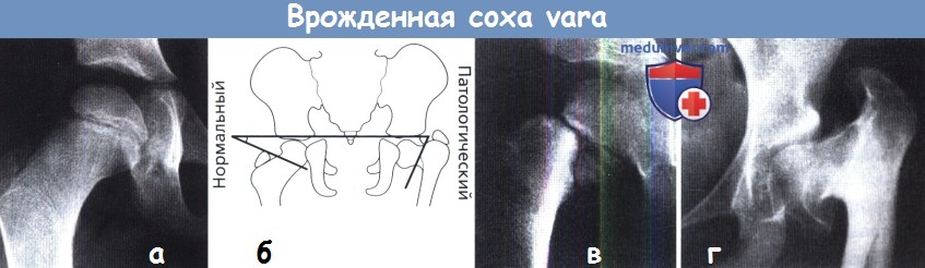 Врожденная coxa vara - варусная деформация шейки бедра
