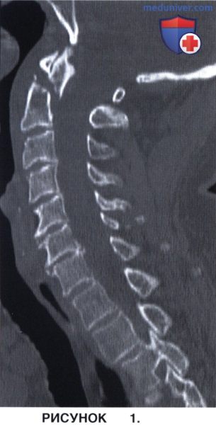 Показания, укладка пациента при заднем спондилодезе С1-С2 по методике Harms