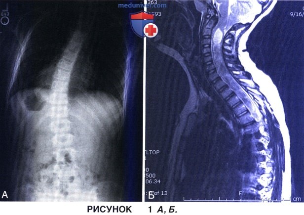Показания, укладка пациента при заднем спондилодезе грудопоясничного отдела позвоночника по поводу подросткового идиопатического сколиоза