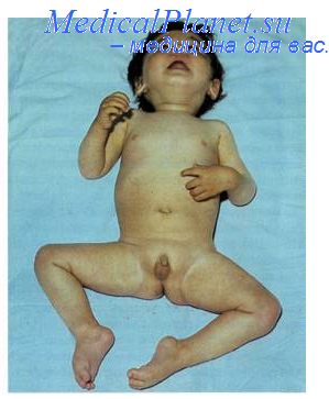 полиомиелит у ребенка