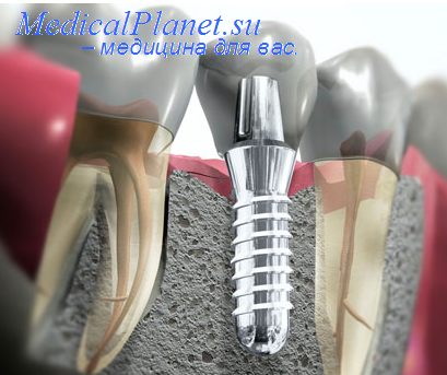 протезы в стоматологии