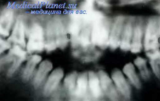 шины при патологии зубов