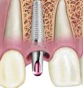 протезирование в стоматологии