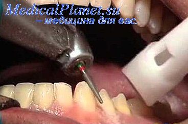 металлы в стоматологии
