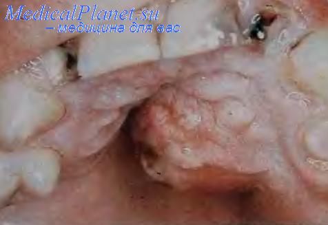 Папилломатоз полости рта. Фиброматоз десен.