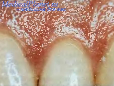 кариес зубов
