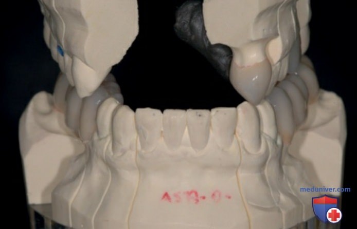 Случай II класса: низкий угол, ортодонтическое лечение с последующим протезированием на имплантатах
