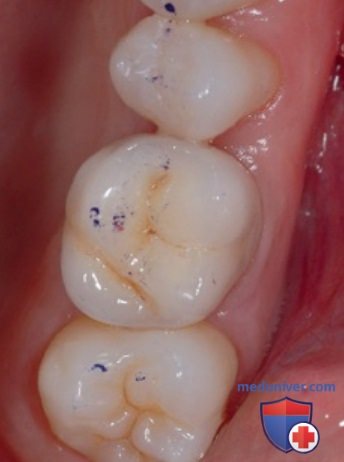 Случай II класса: низкий угол, ортодонтическое лечение с последующим протезированием на имплантатах