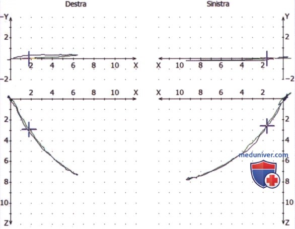 Изменение вертикального соотношения и протезирование на имплантатах в случае III класса с низким углом