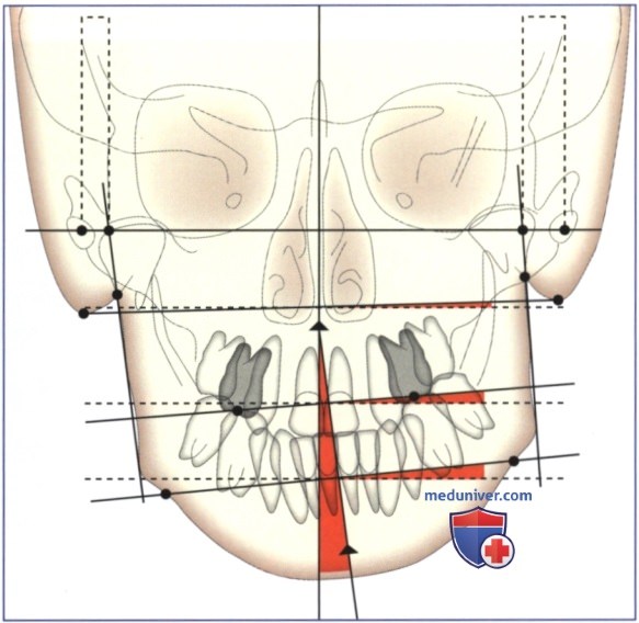 Фронтально-дистальный трейсинг в планировании эстетики положения нижней челюсти