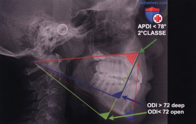 Сагиттальный анализ скелетного класса при оценке положения нижней челюсти