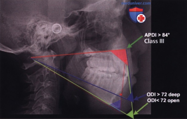 Сагиттальный анализ скелетного класса при оценке положения нижней челюсти