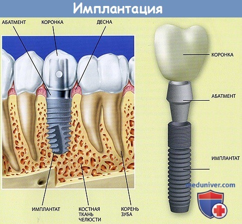 Восстановление зуба с помощью имплантации