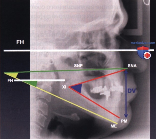 Трёхмерное управление вертикальным соотношением зубных дуг