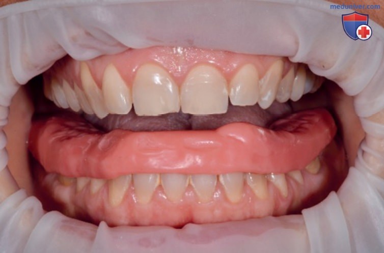 Трёхмерное управление вертикальным соотношением зубных дуг