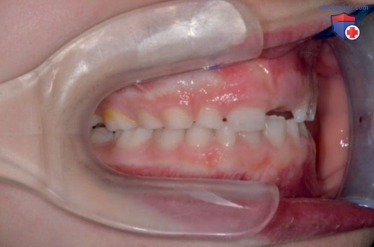 Развитие зубных рядов с точки зрения окклюзионной концепции