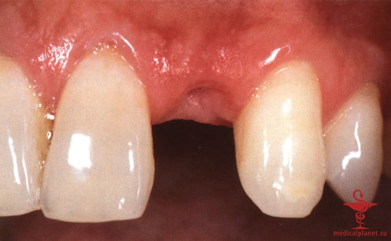 ���������������� ������ ����������� ����������� ����� � ����������� �������� ����