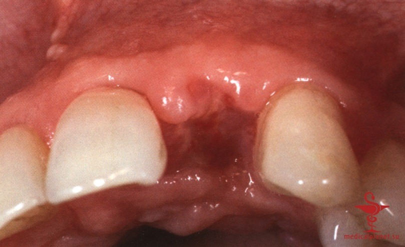 ���������������� ������ ����������� ����������� ����� � ����������� �������� ����