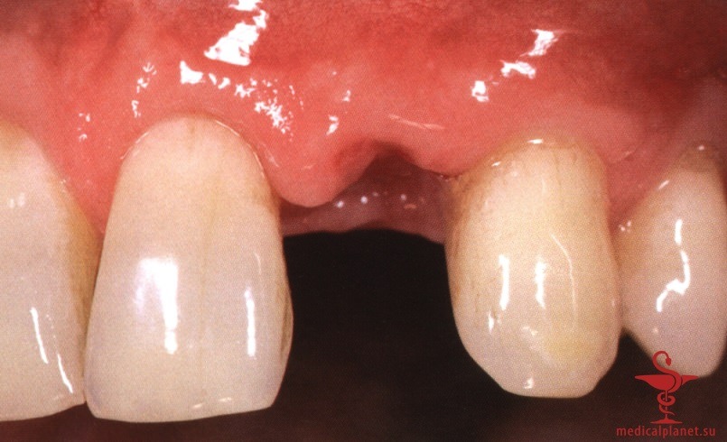 ���������������� ������ ����������� ����������� ����� � ����������� �������� ����