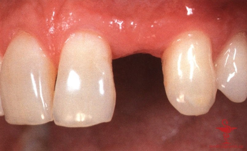 ���������������� ������ ����������� ����������� ����� � ����������� �������� ����