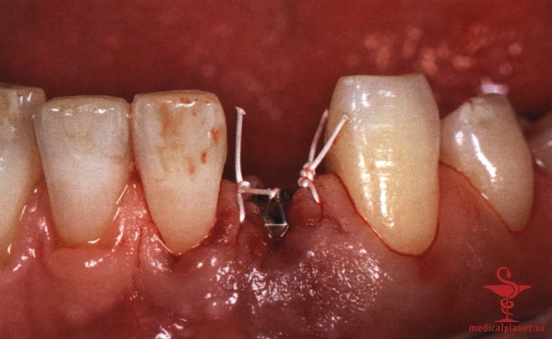 ���������������� ������ ����������� ����������� ����� � ����������� �������� ����