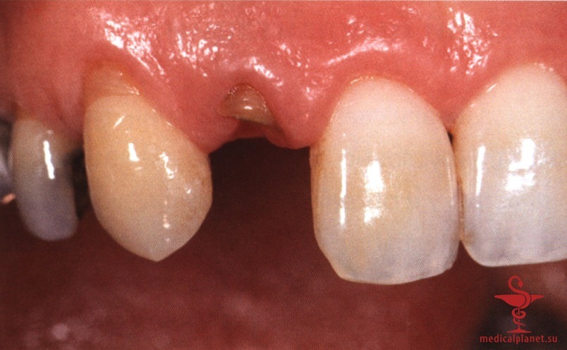 ���������������� ������ ����������� ����������� ����� � ����������� �������� ����