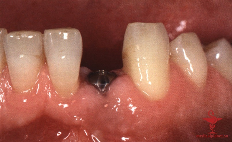 ���������������� ������ ����������� ����������� ����� � ����������� �������� ����