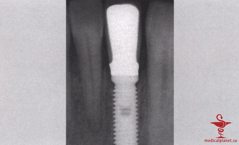 ���������������� ������ ����������� ����������� ����� � ����������� �������� ����