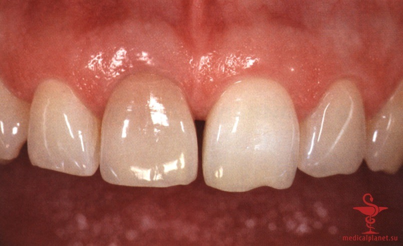 ���������������� ������ ����������� ����������� ����� � ����������� �������� ����