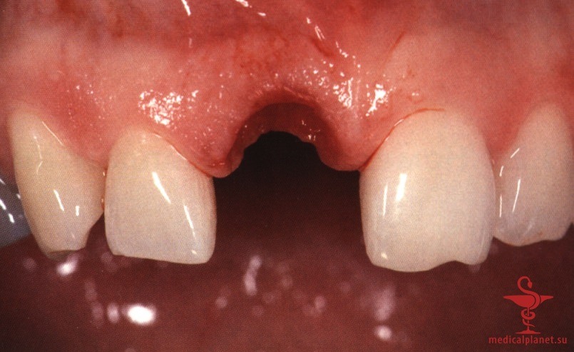 ���������������� ������ ����������� ����������� ����� � ����������� �������� ����