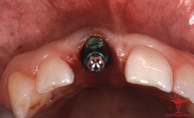 ���������������� ������ ����������� ����������� ����� � ����������� �������� ����