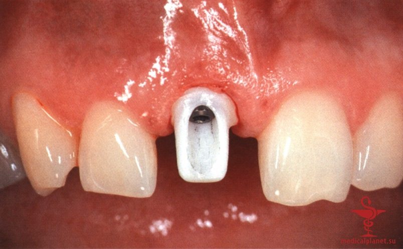 ���������������� ������ ����������� ����������� ����� � ����������� �������� ����